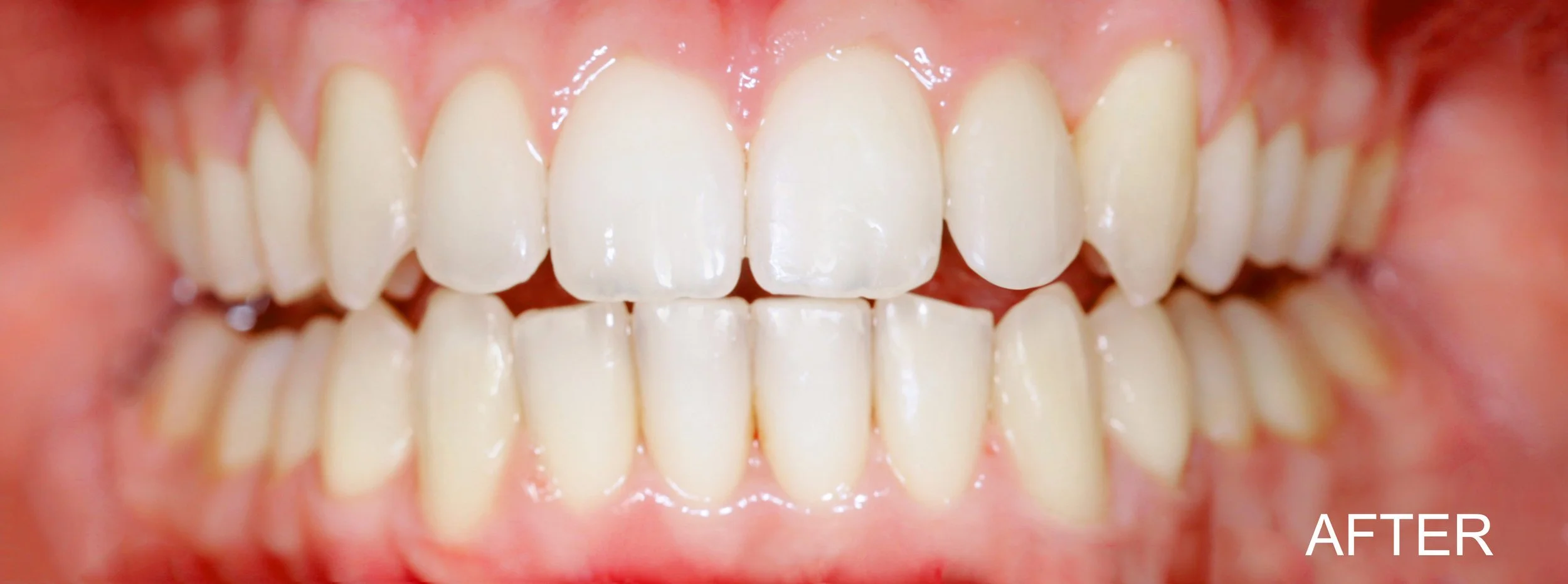 Invisalign 1 AFTER.jpg