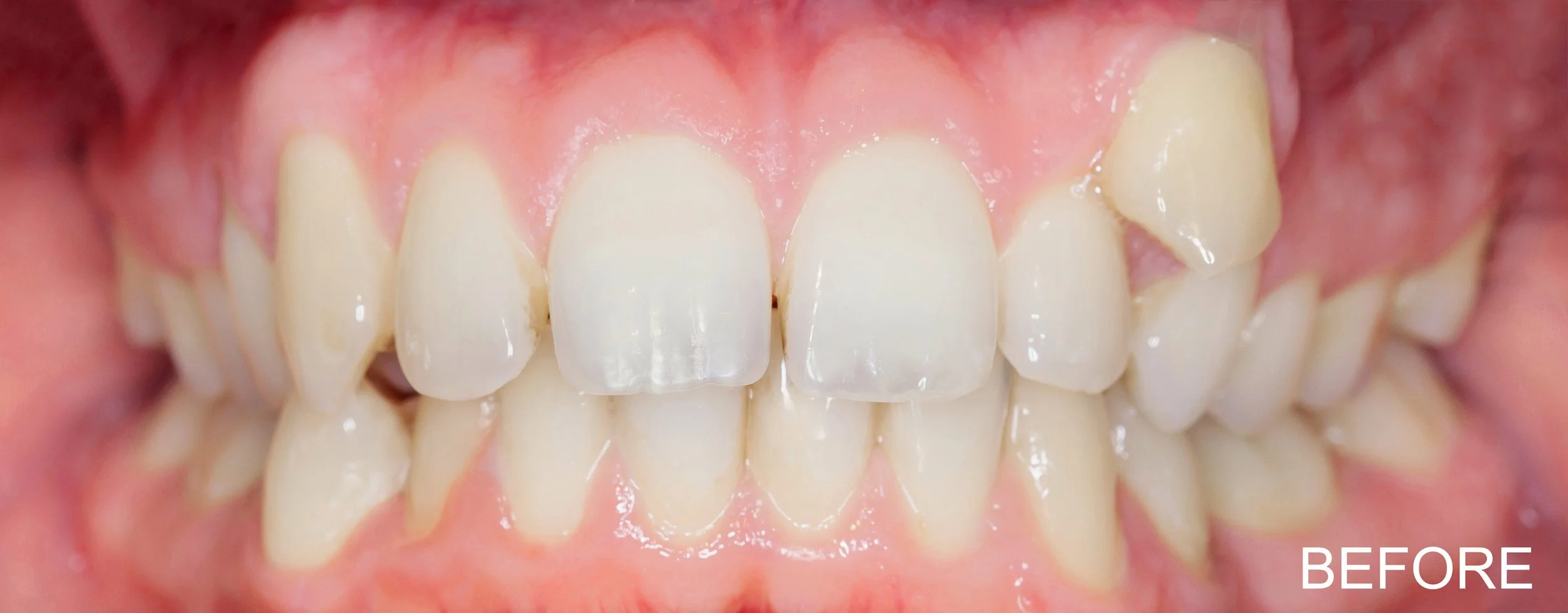 Invisalign 1 BEFORE.jpg