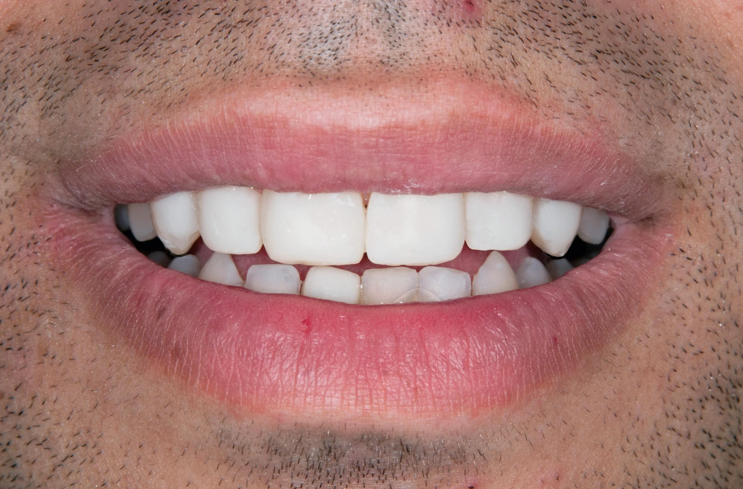 Invisalign 2 AFTER.jpg