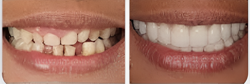 Smile Reconstruction