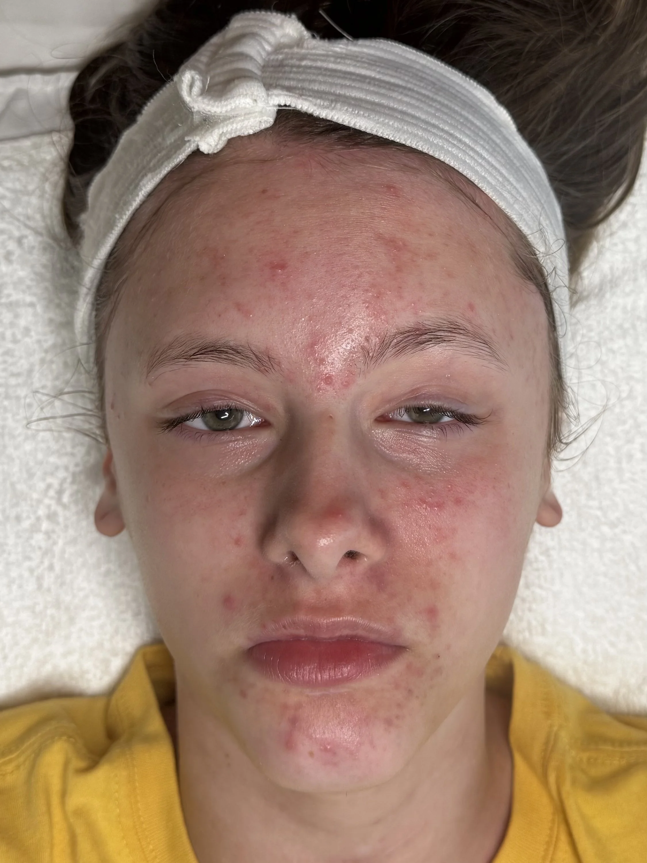 acne treatments, Augusta, GA