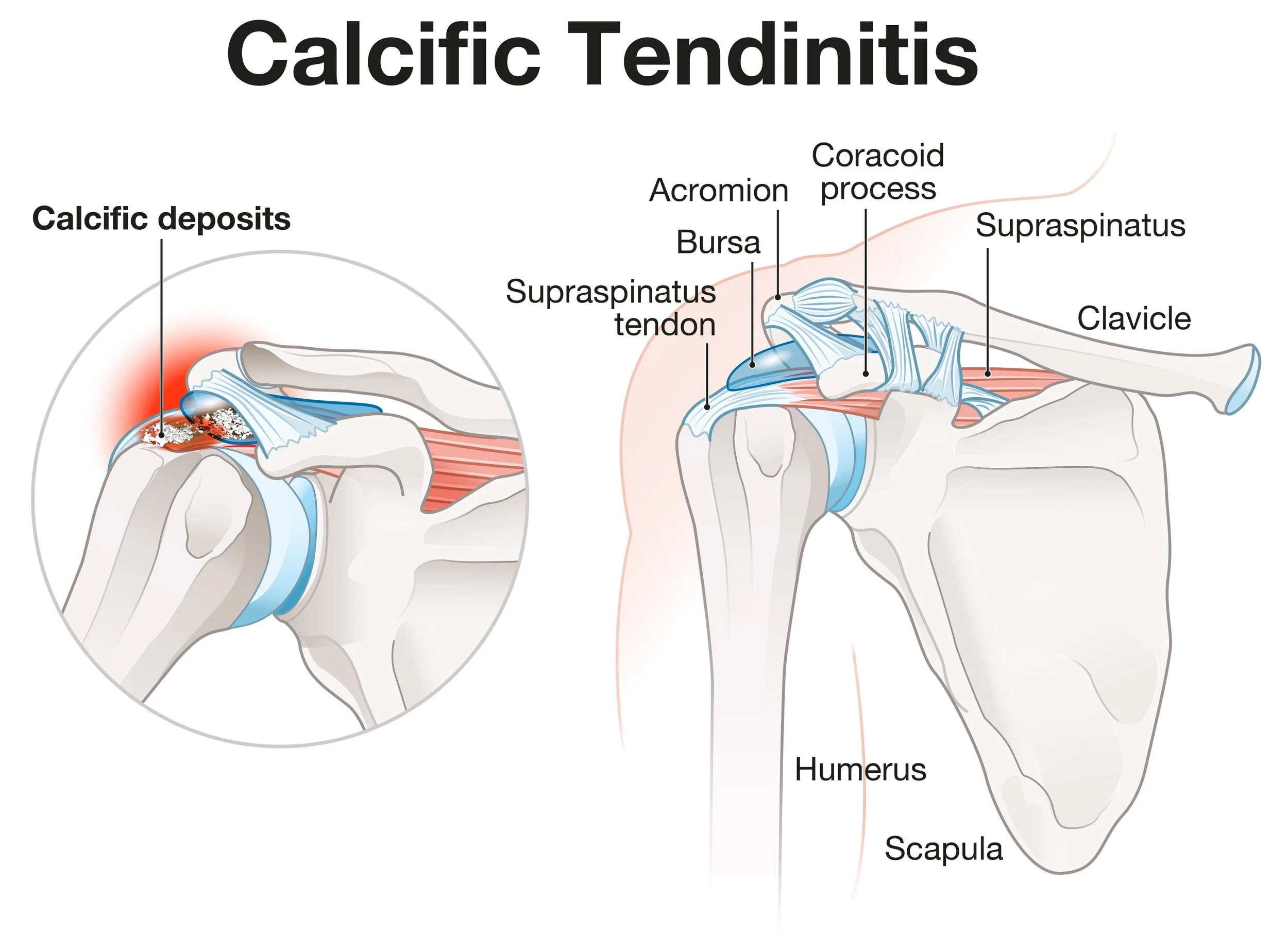 Calcific Tendonitis: How to Dissolve Shoulder Calcium Without Surgery in East Auckland