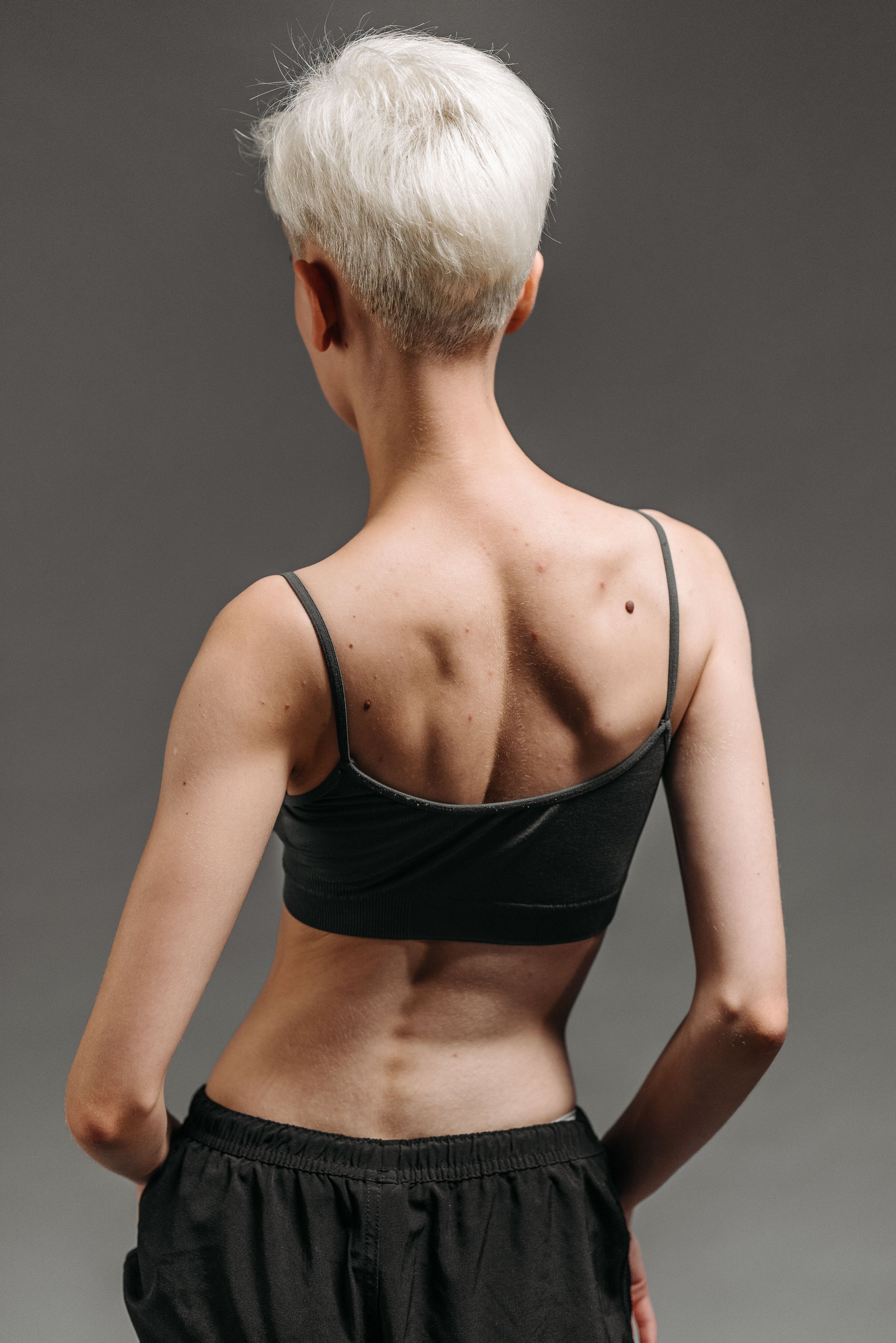 Schroth method scoliosis management at Velca