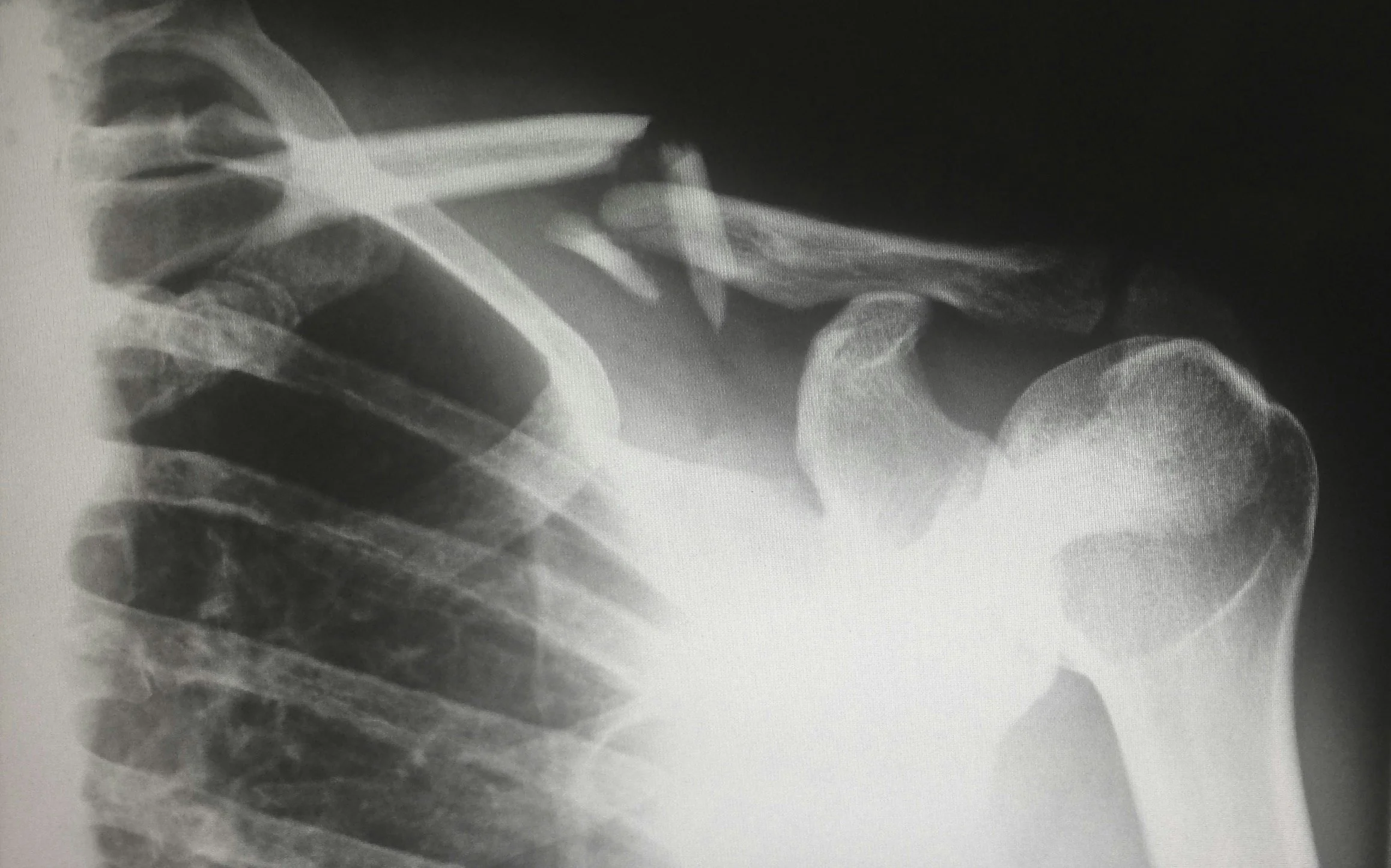X-ray of a shoulder showing the humerus, scapula, and clavicle bones.