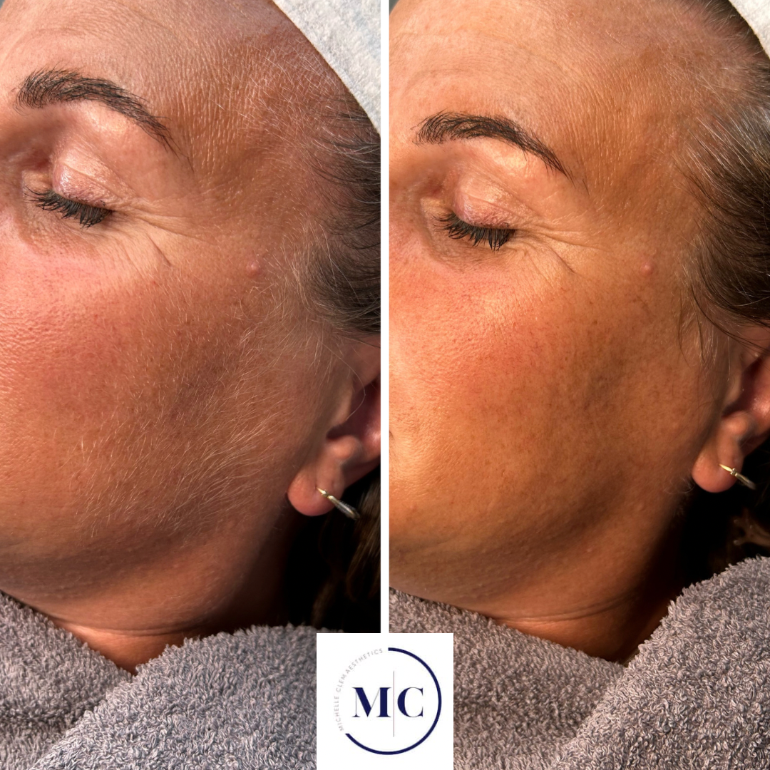 Side-by-side comparison of facial skin showing improved texture and tone, likely after skincare treatment, with a close-up of a woman's face with closed eyes and eyebrows, and a towel wrapped around her neck.