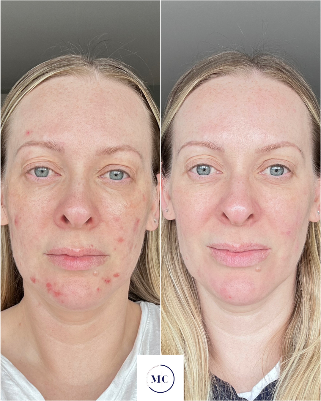 A side by sode image of a lady with skin sores and a broken barrier and the after shows the results after three months of using skincare with better skin