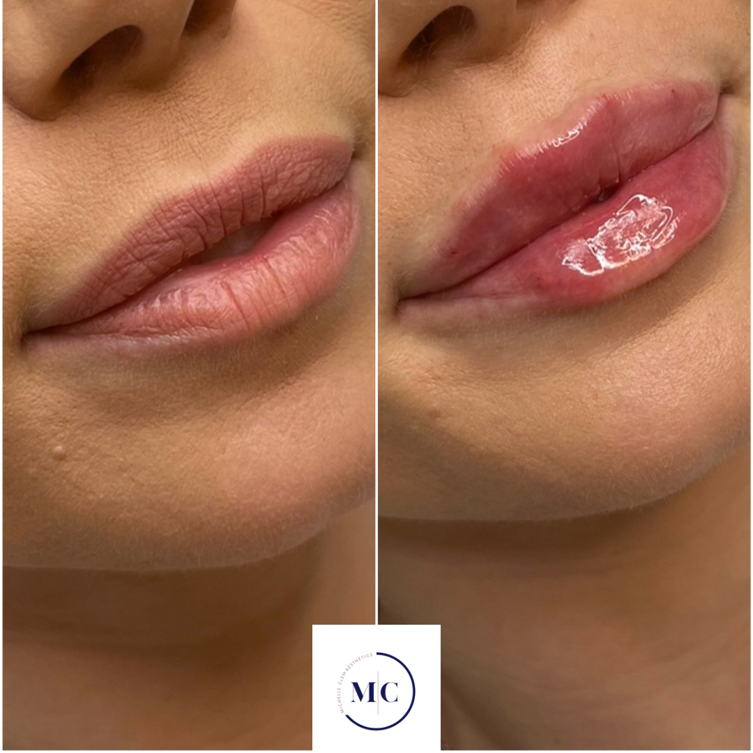 Comparison of a woman's face before and after a skincare or cosmetic treatment, showing improved skin texture and tone.