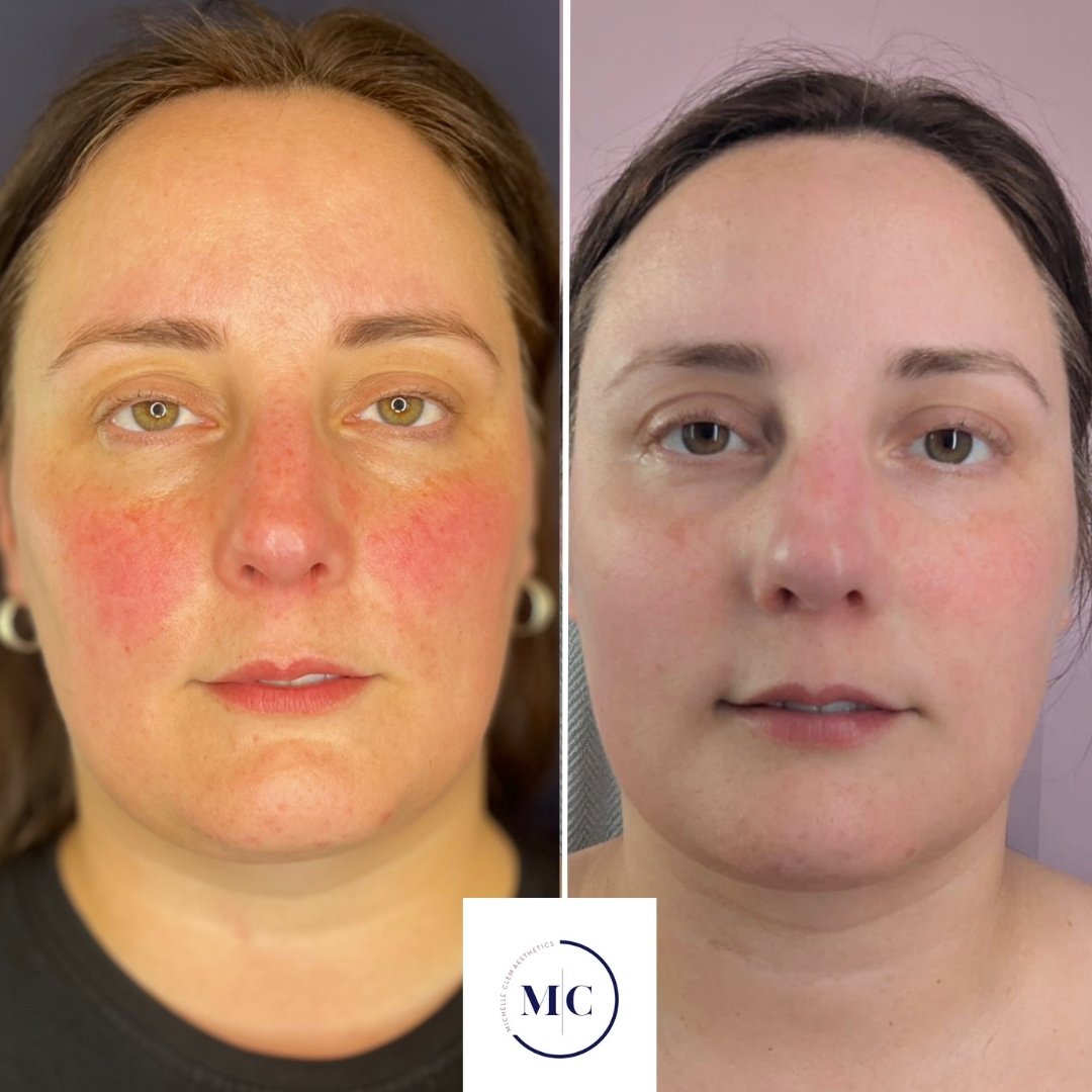 Before and after image of a treatment with botox for rosecea using microtox