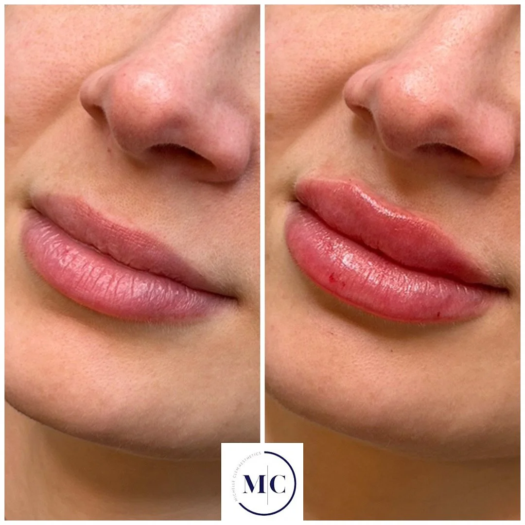 A side-by-side comparison of a woman's face during a beauty treatment, lying down with eyes closed, wearing a black headband with the word 'LASH' on it, with a gray towel draped over her. The left shows her face before the treatment, and the right shows her face after, with smoother, more lifted skin.