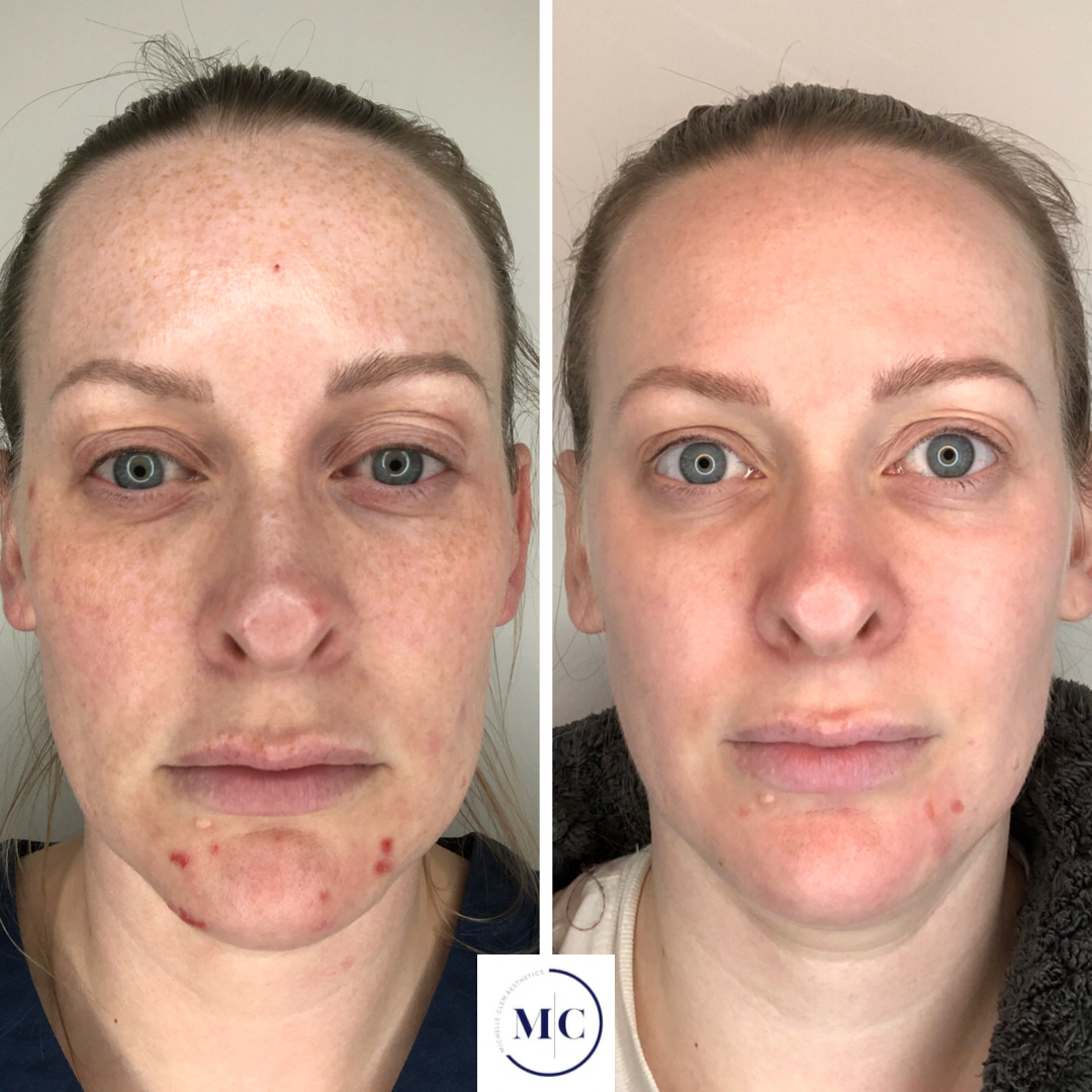Side-by-side comparison of a woman with acne and freckles before and after skin treatment; the left image shows more acne, redness, and freckles, while the right image shows clearer skin with reduced acne and redness.