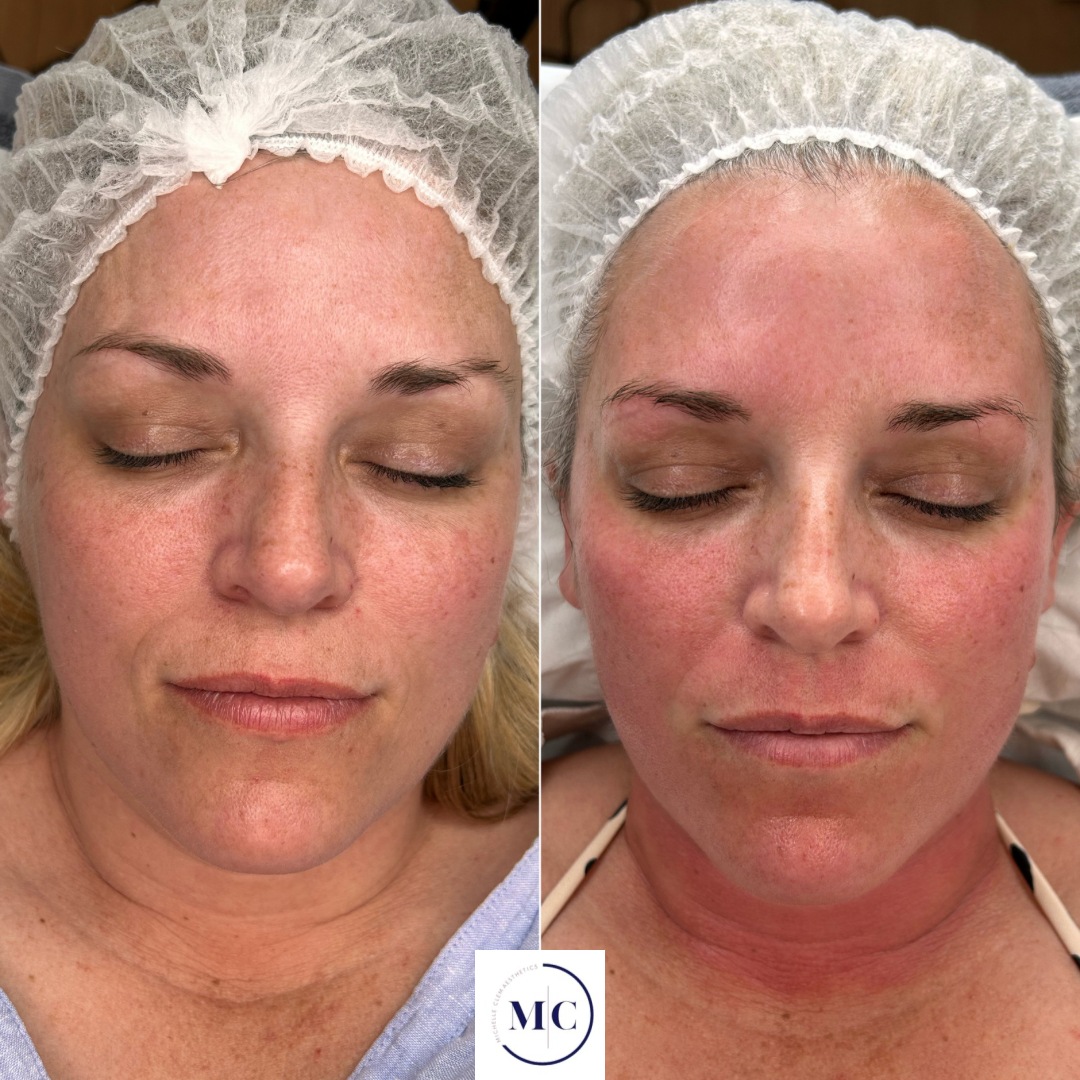 Before and after close-up of a person's face showing improved skin texture and reduced acne and dryness around the lips and chin, with visible freckles, a nose piercing, and partially closed eyes.