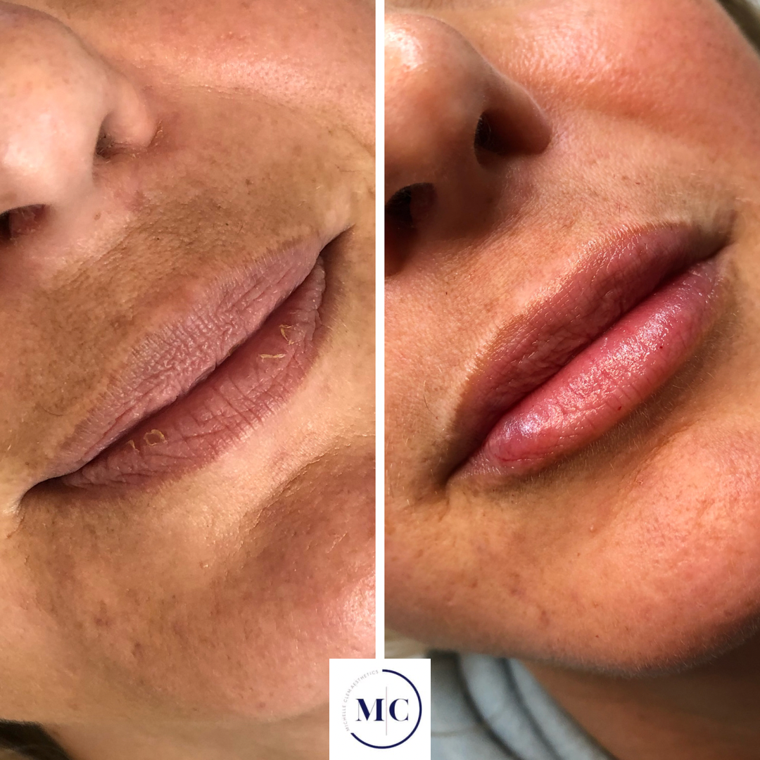Close-up of a person's lips and surrounding skin, showing before and after results of a cosmetic treatment, with smooth, plump lips and clearer skin in the after photo.