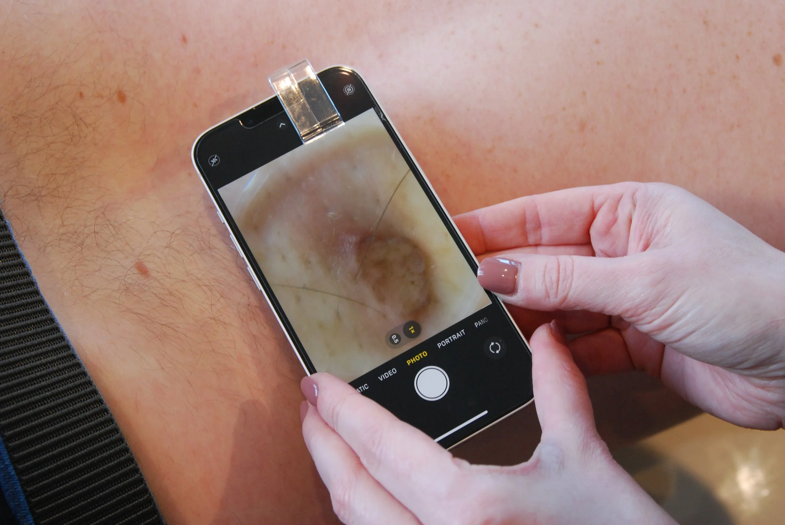 Close-up of hands taking a close-up photo of a person's skin with a smartphone.