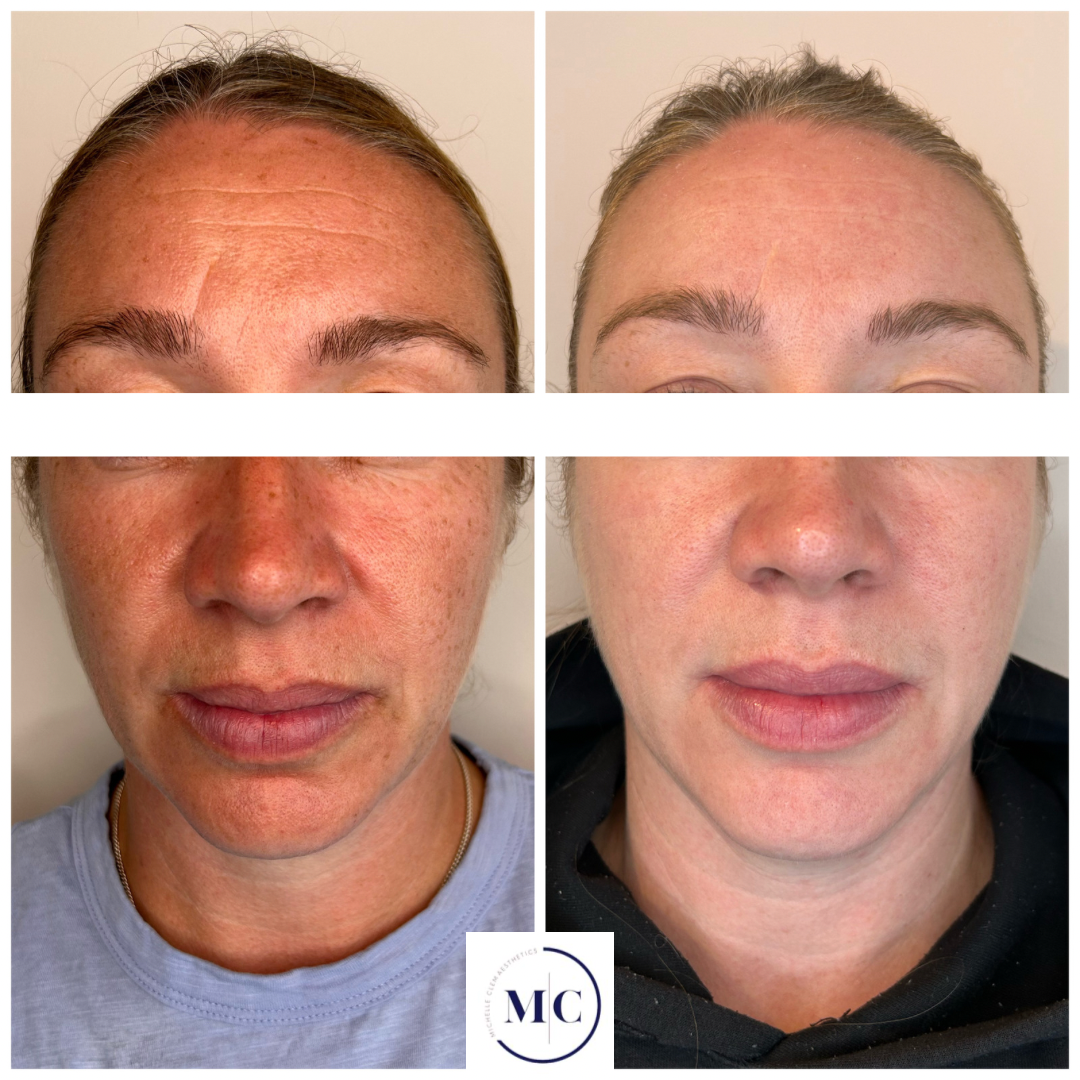 Side-by-side comparison of a person's face before and after skincare treatment, showing improved skin texture and tone.