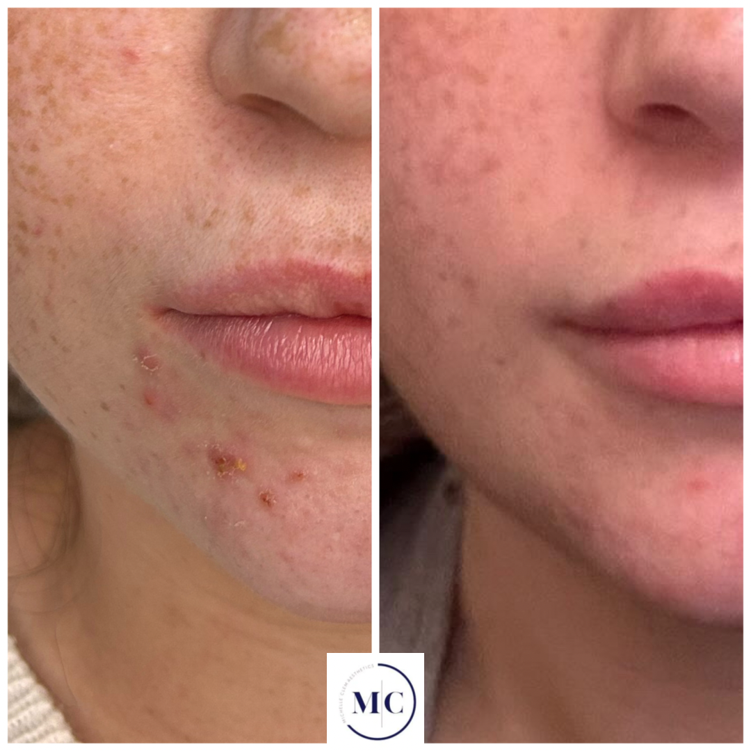 Side-by-side comparison of a person's lower face showing improvement in skin condition, with acne and redness on the left and clearer skin on the right.