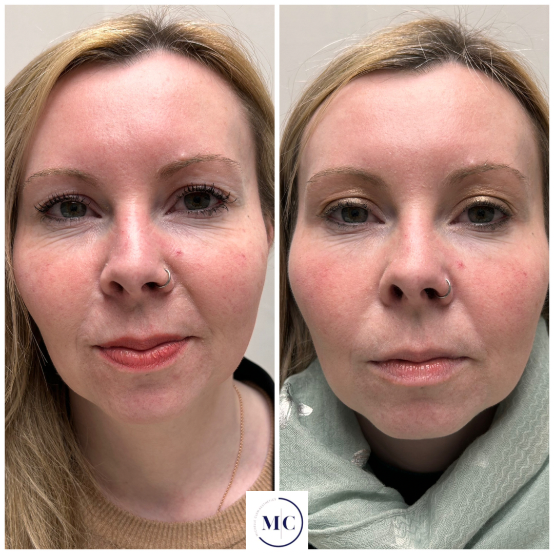 Close-up of a woman’s eye and surrounding skin, showing before and after cosmetic treatment, featuring long eyelashes, well-shaped eyebrows, and smooth skin.