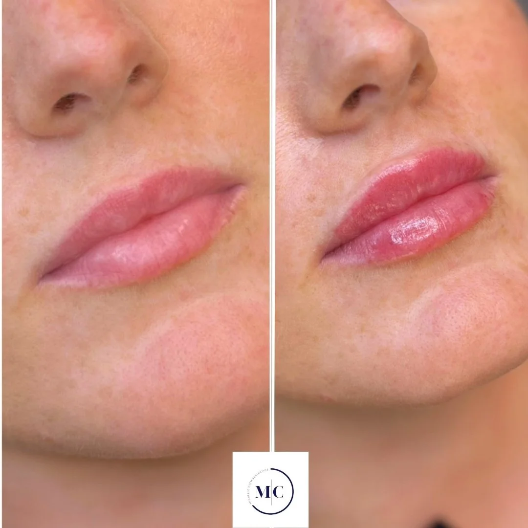 SIde by side before and after images of lip filler with natural results showing a plump, fuller lip