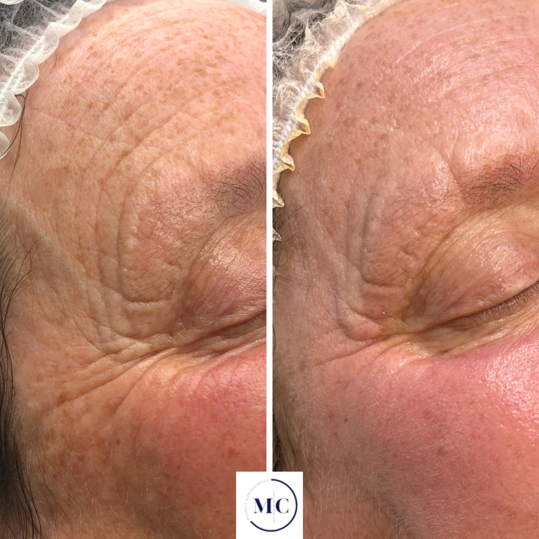 Side-by-side comparison of a woman with before and after skin treatment, showing improved skin texture and redness reduction.