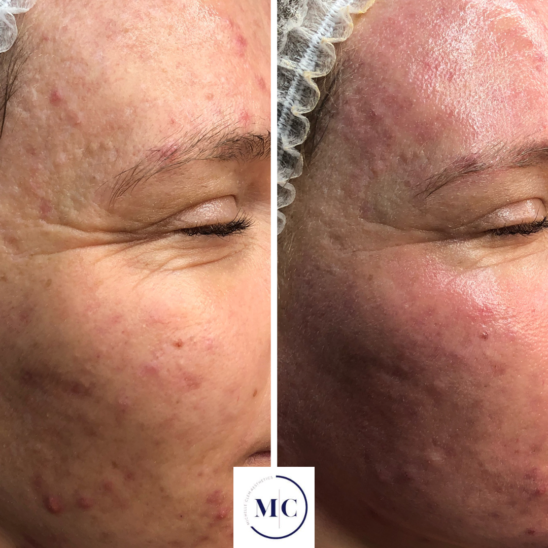 A side-by-side comparison of a person's face showing skin before and after a skincare treatment. The left side displays acne, blemishes, and redness. The right side shows clearer, smoother skin with reduced blemishes and redness.