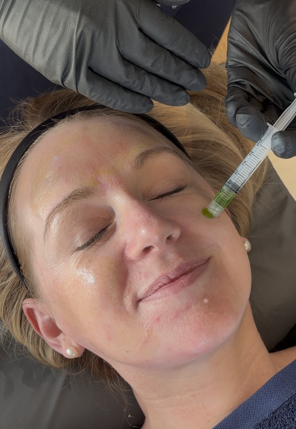A woman receiving a cosmetic injection near her eye while lying down with eyes closed, with a healthcare professional wearing black gloves administering the treatment.
