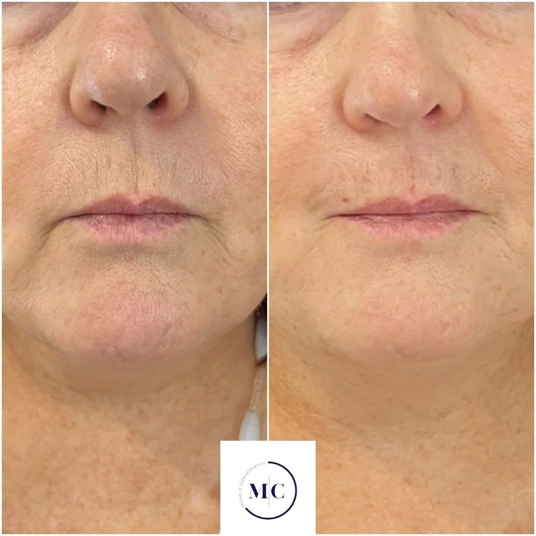 A side by side comparison of a lady with marionette lines and upper lip lines treated with dermal filler to soften them