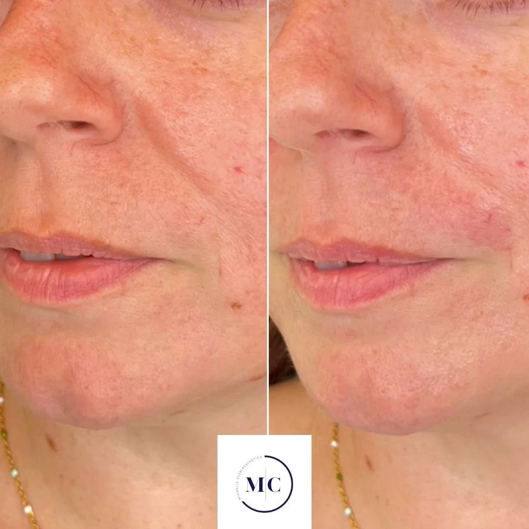 A side by side comparison of a lady with pronounced nasolabial folds and an after picture using dermal filler to soften the lines