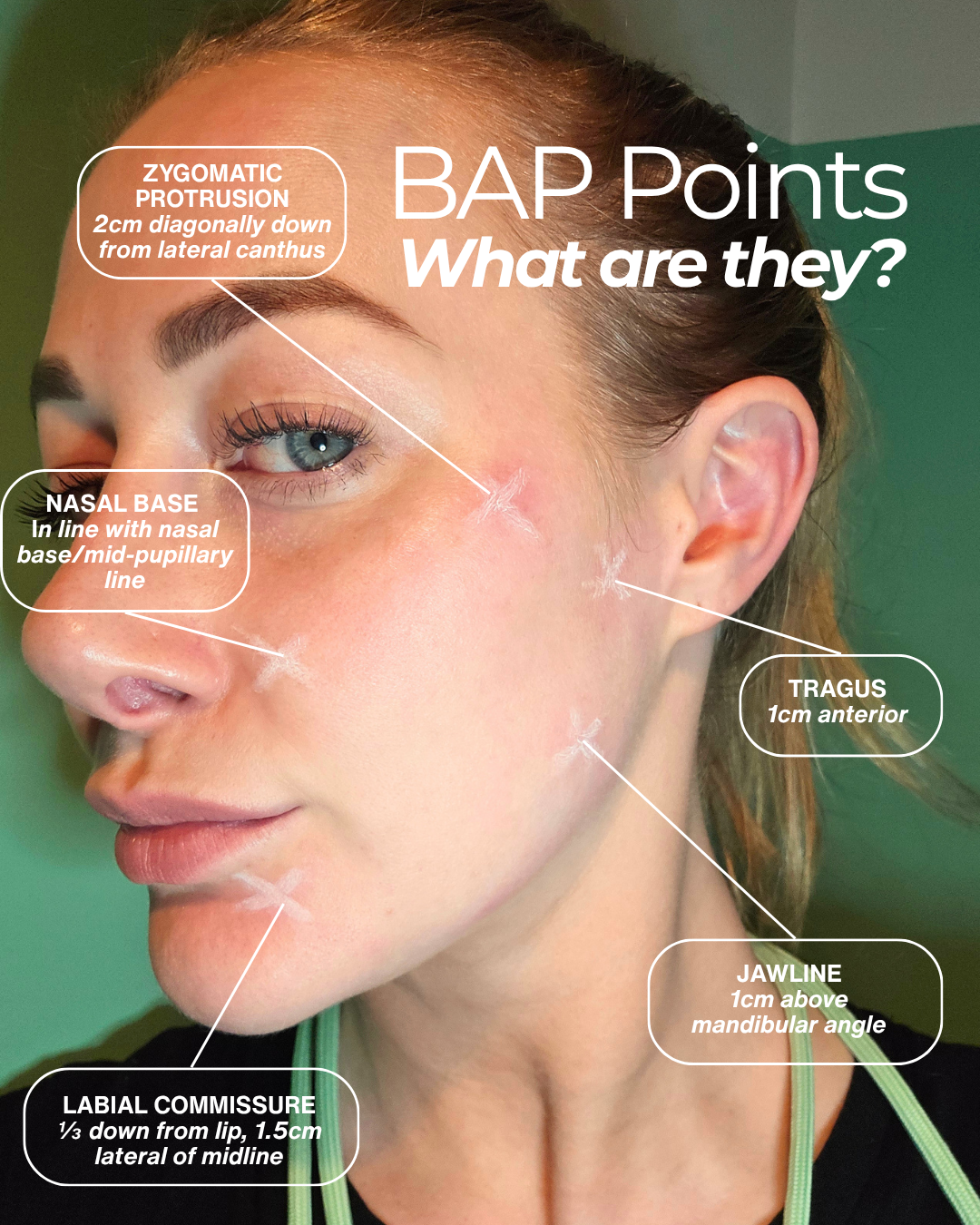 BAP Points vs Cannula Technique in Skin Boosters: What’s the Difference?