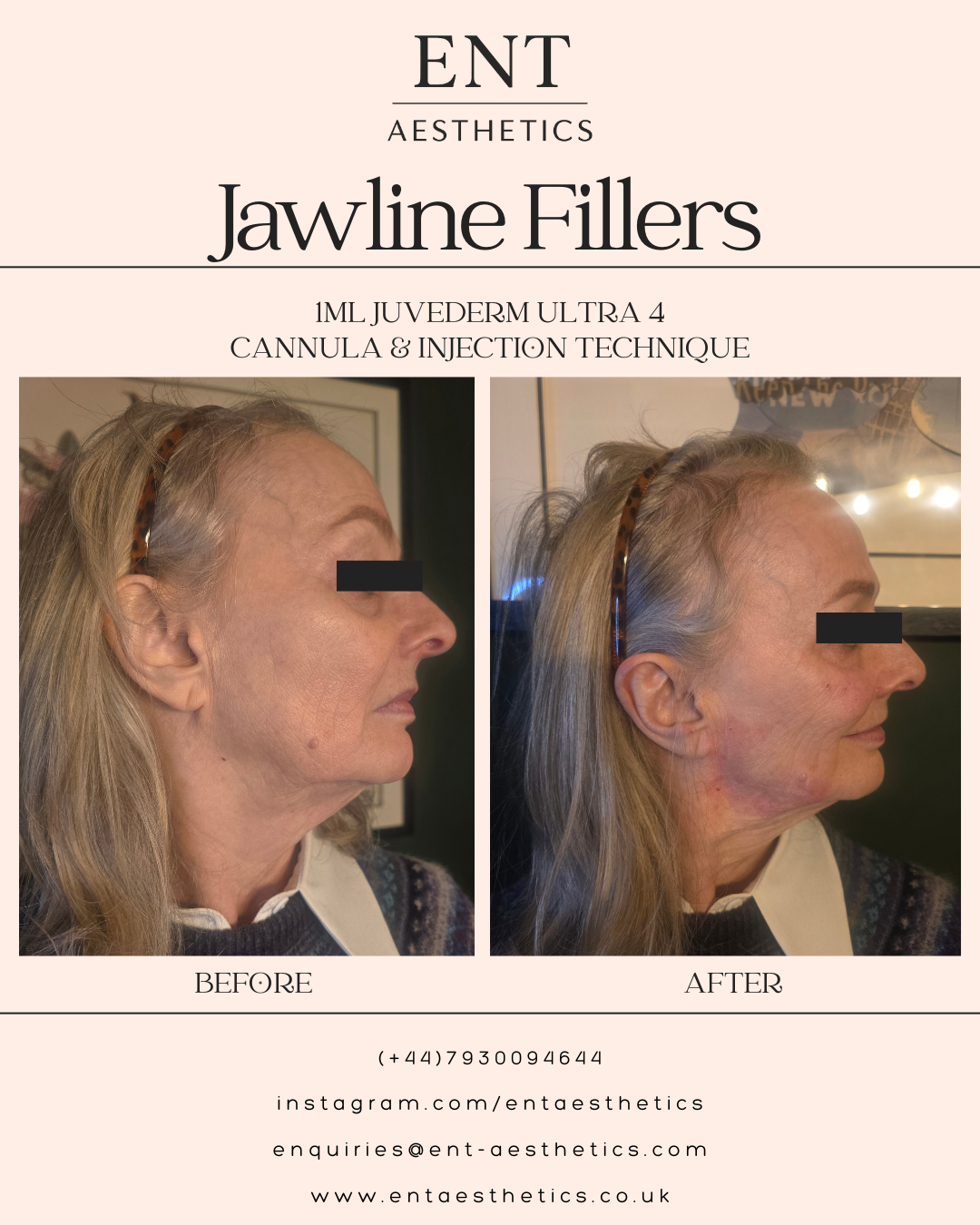 Dermal Fillers Mum 17.2.26-2.png