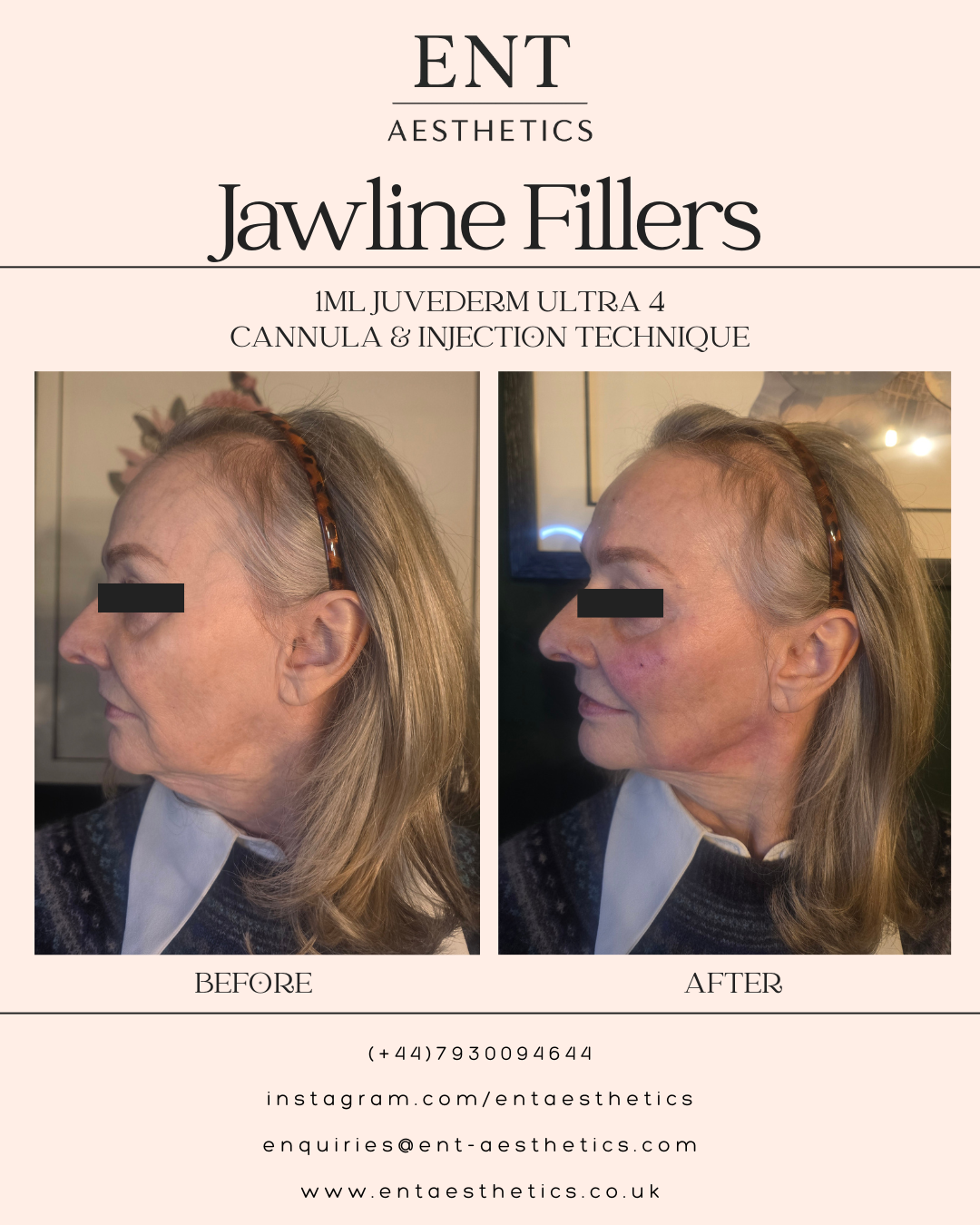Dermal Fillers Mum 17.2.26-2.png