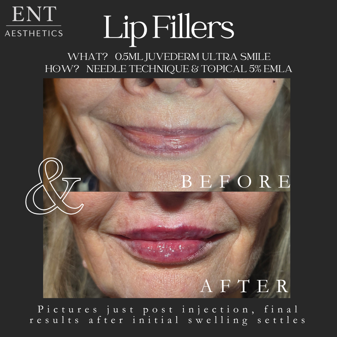 LIP FILLERS Client 1.png