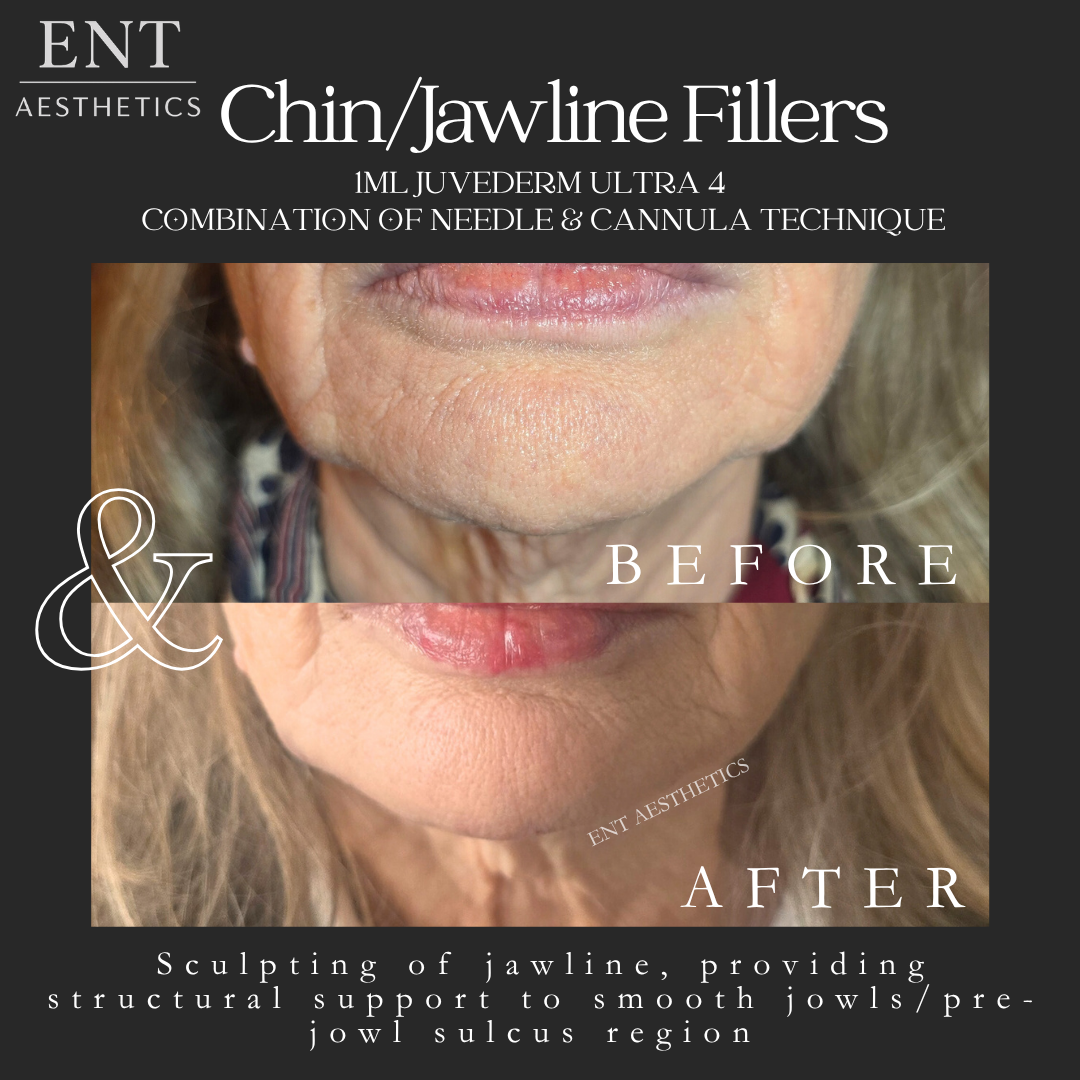 Chin Fillers 16.3.26.png