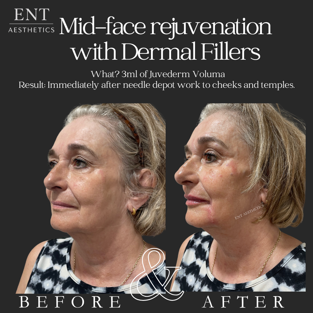 Before and after images of a middle-aged woman showing mid-face rejuvenation with dermal fillers, focusing on cheek and temple enhancement, with text describing the procedure and results.