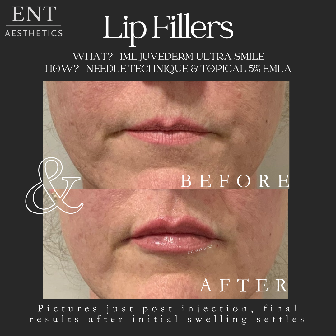 Copy of LIP FILLERS Client 2.png