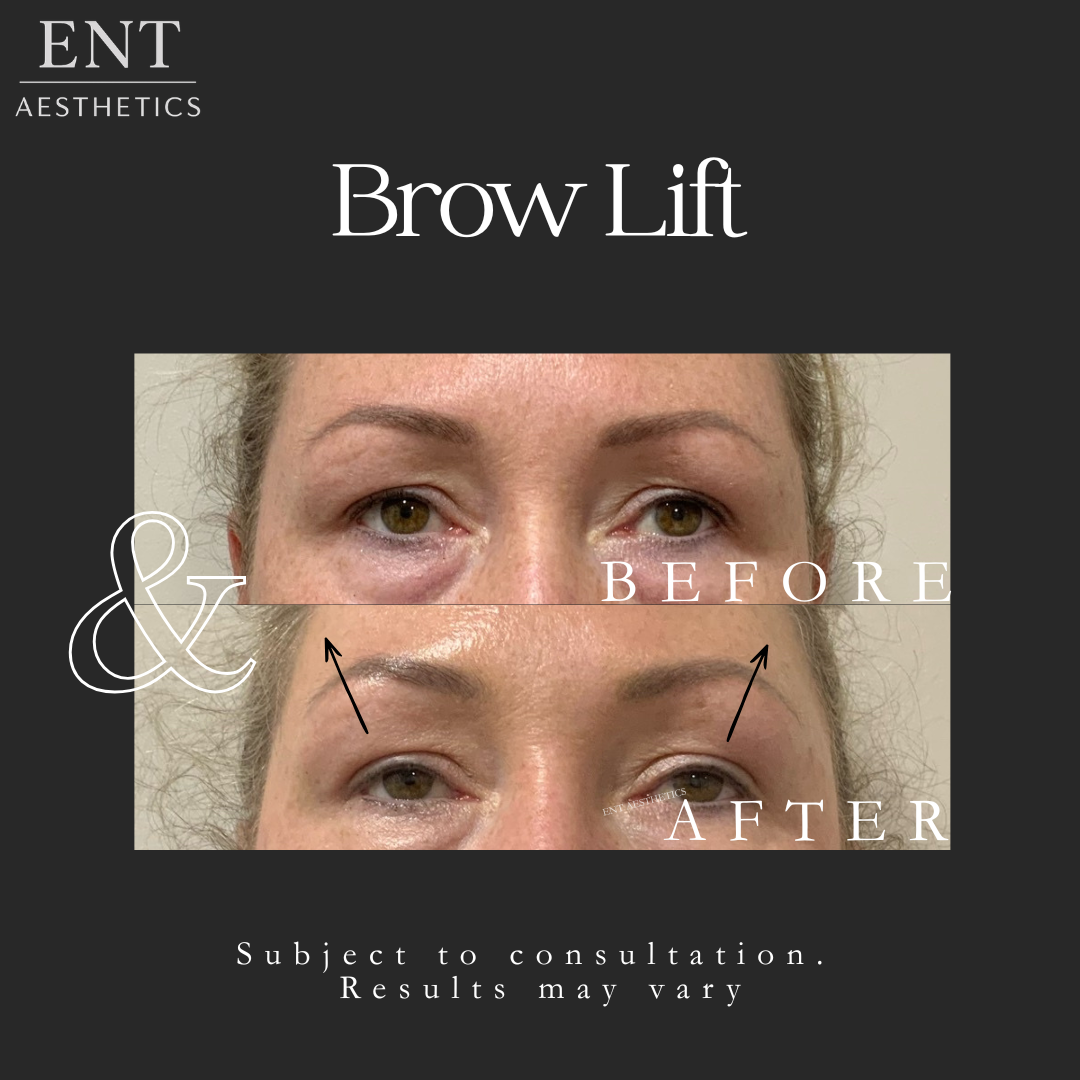 BROW LIFT 24.3.36.png