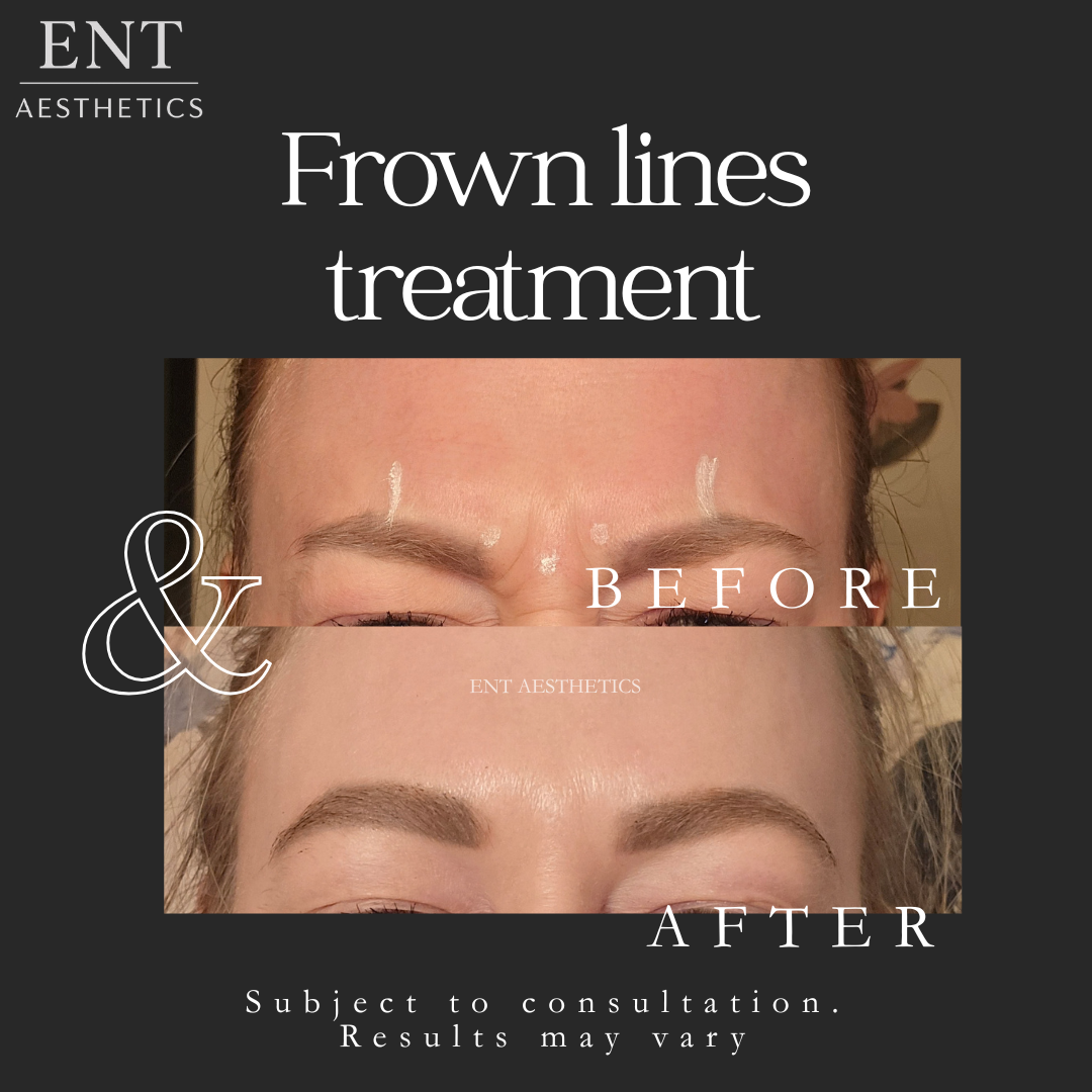 Botox Glabellar & frontalis me 25.3.26-2.png