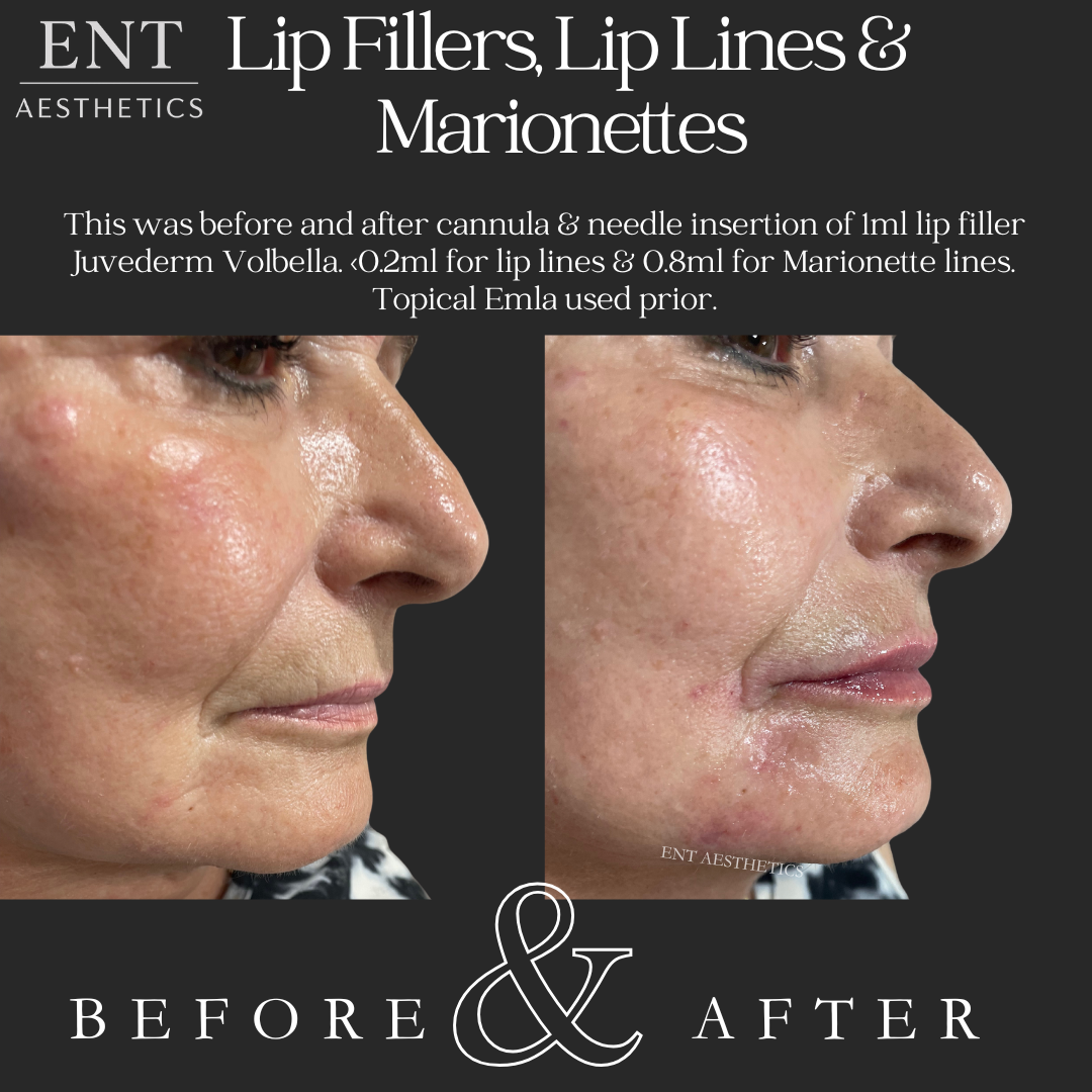 Side-by-side comparison of a woman's face showing before and after lip filler treatment, with noticeable smoothing of lips and reduced wrinkles.