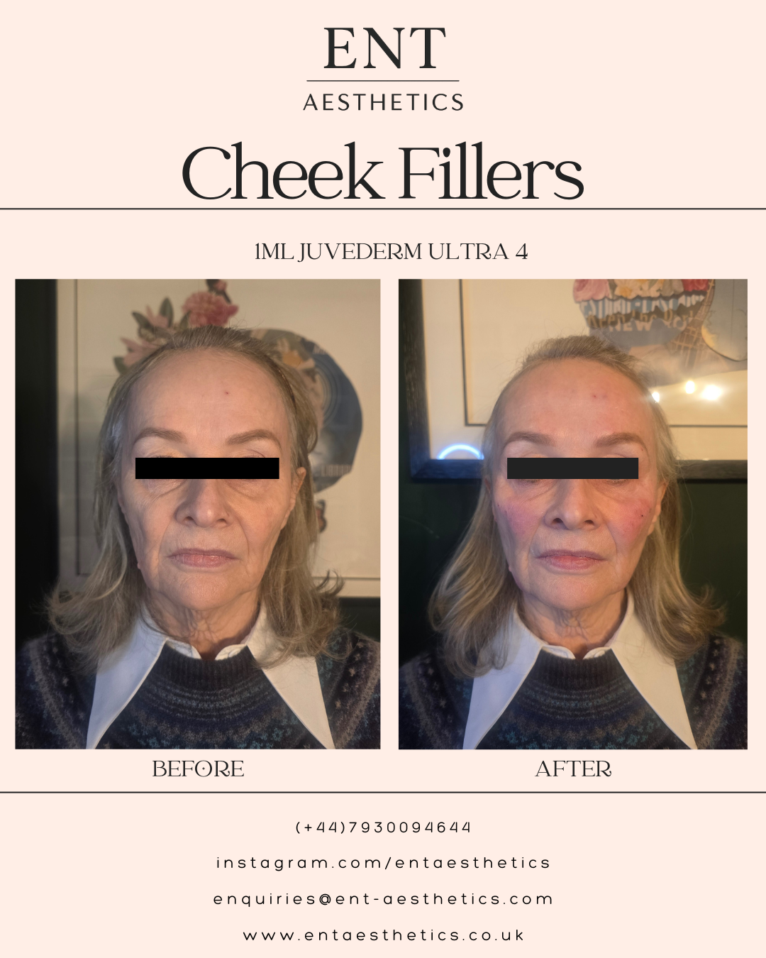 Dermal Fillers Mum 17.2.26-3.png