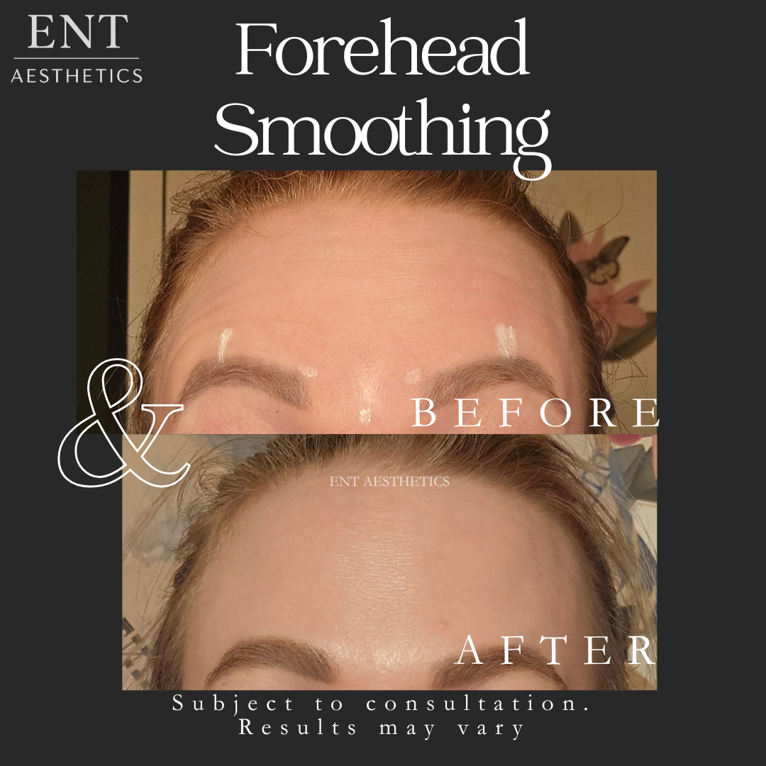 Botox Glabellar & frontalis me 25.3.26.png