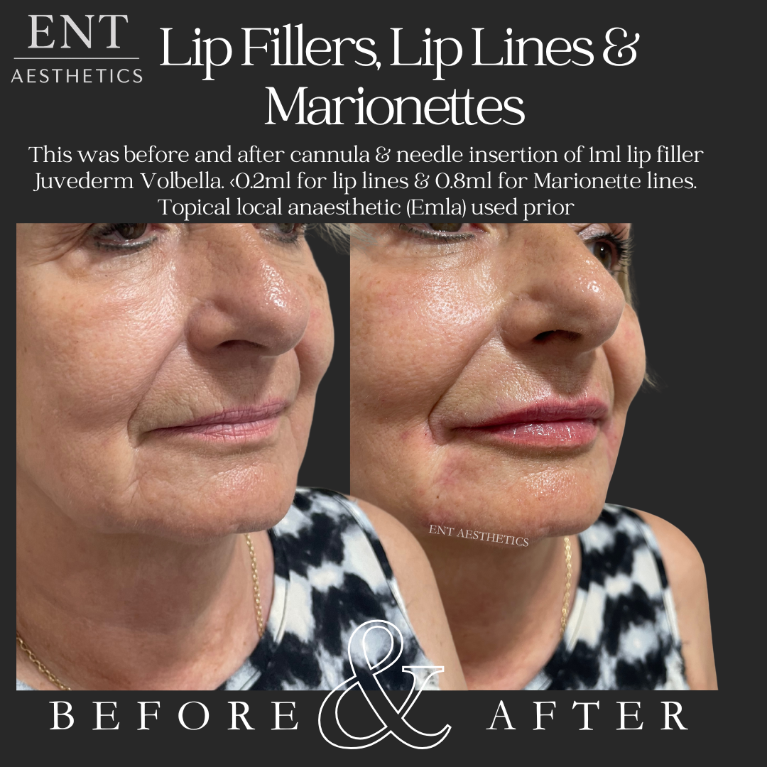 Side-by-side comparison of a woman's face before and after lip filler treatment, showing improved lip volume and smoother skin, with text explaining the procedure and products used.