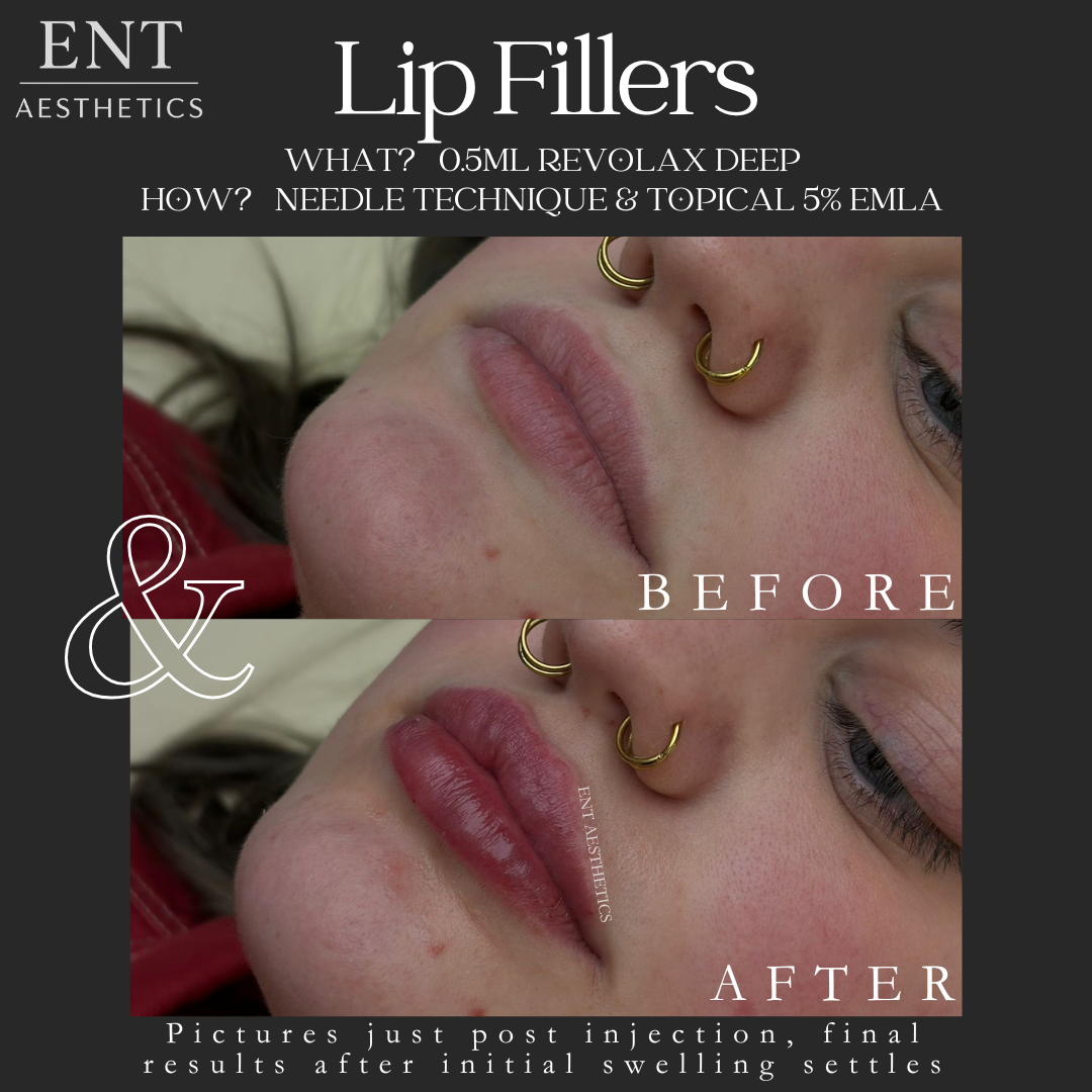 LIP FILLERS Client 22.4.26.png