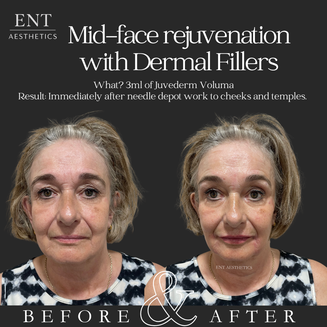 Side-by-side photos of a middle-aged woman before and after mid-face rejuvenation with dermal fillers, showing facial improvements.