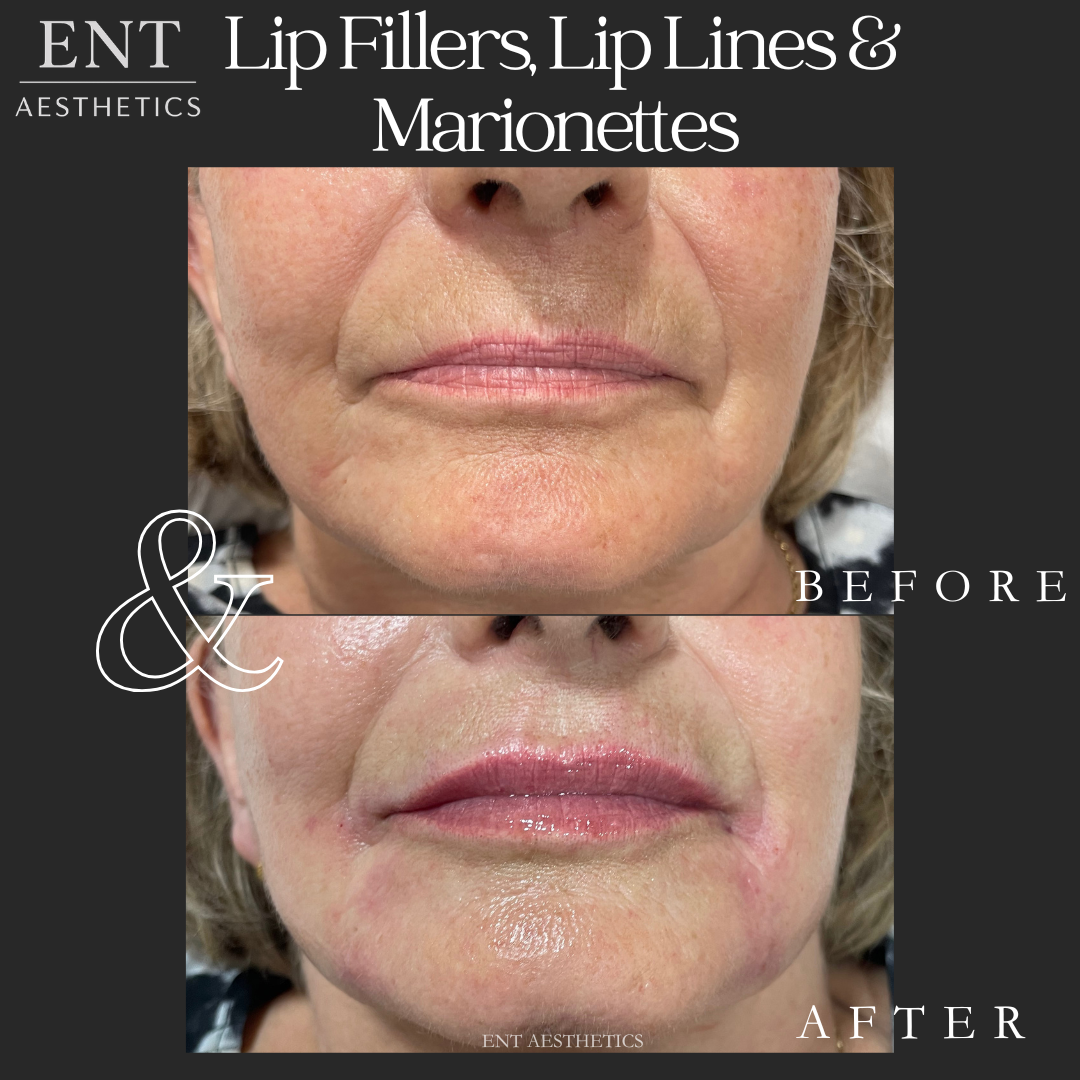 Comparison of lips before and after cosmetic lip fillers and enhancements, showing increased volume and definition.