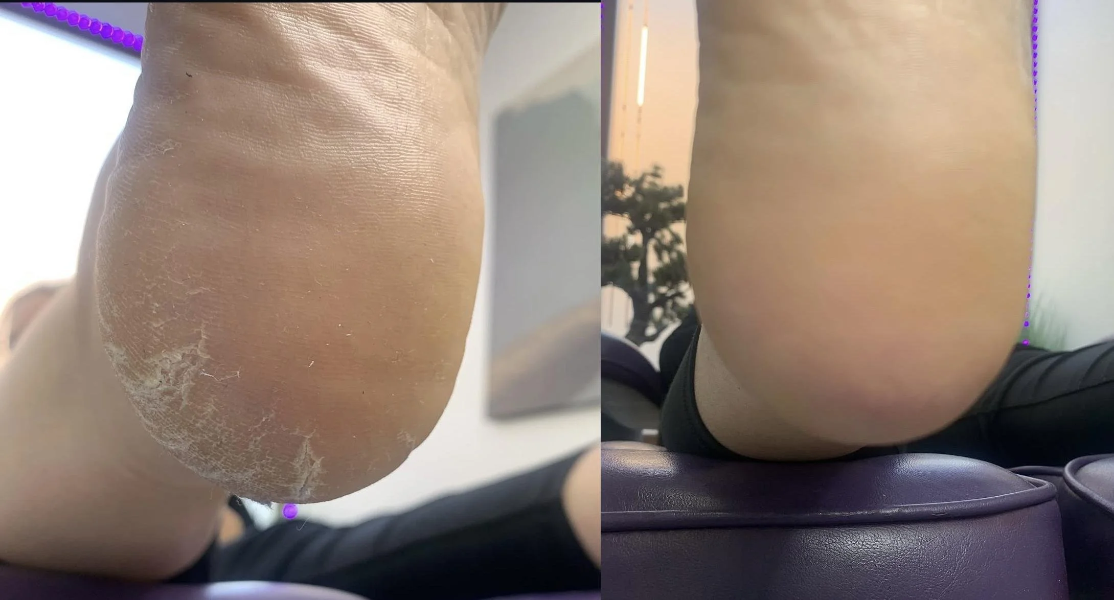 Close-up of a person's heel with dry, peeling skin on the left and smooth, healthy skin on the right.