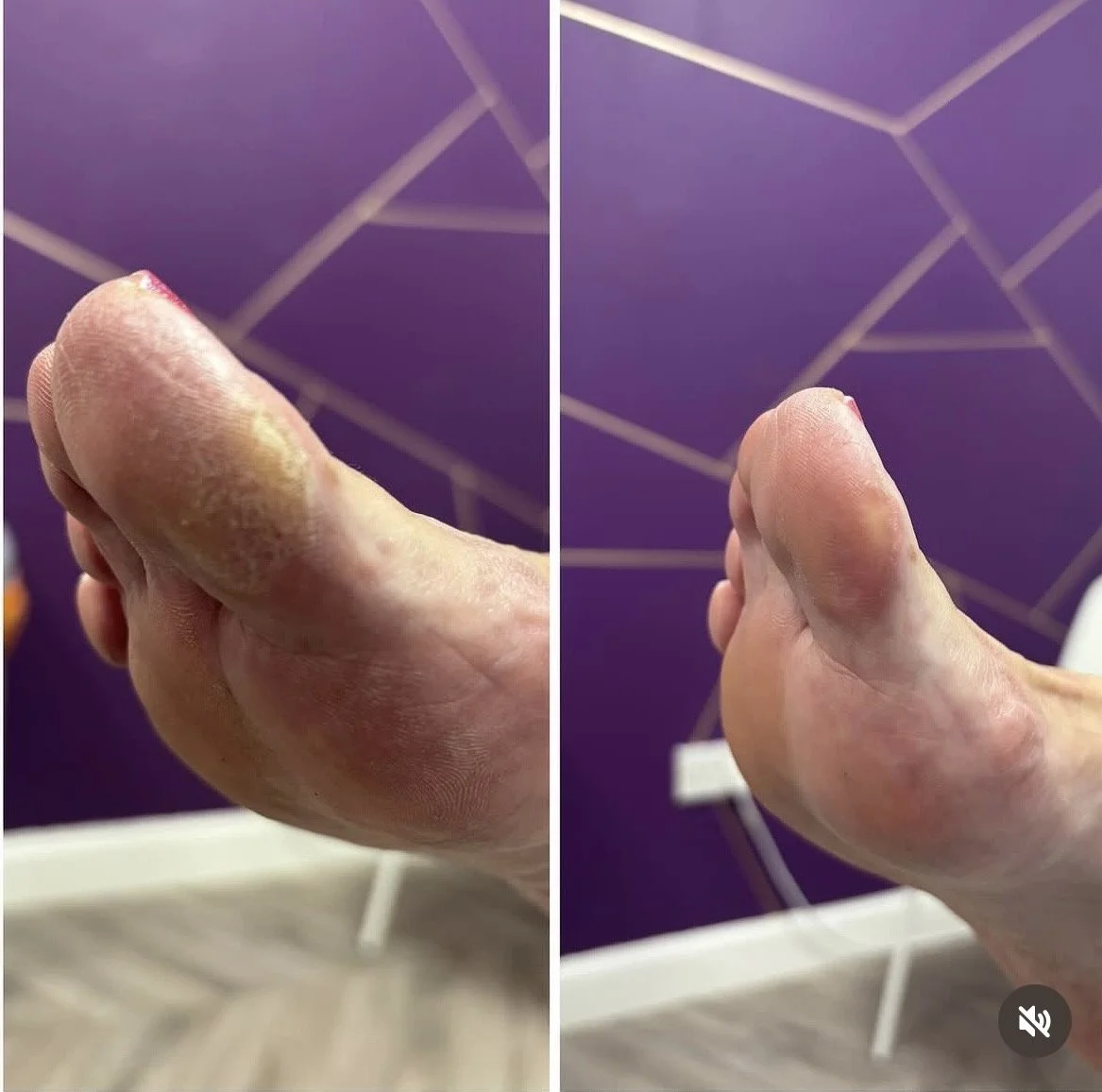 Comparison of a thumb before and after treatment showing improvements in skin condition, with a purple patterned background.