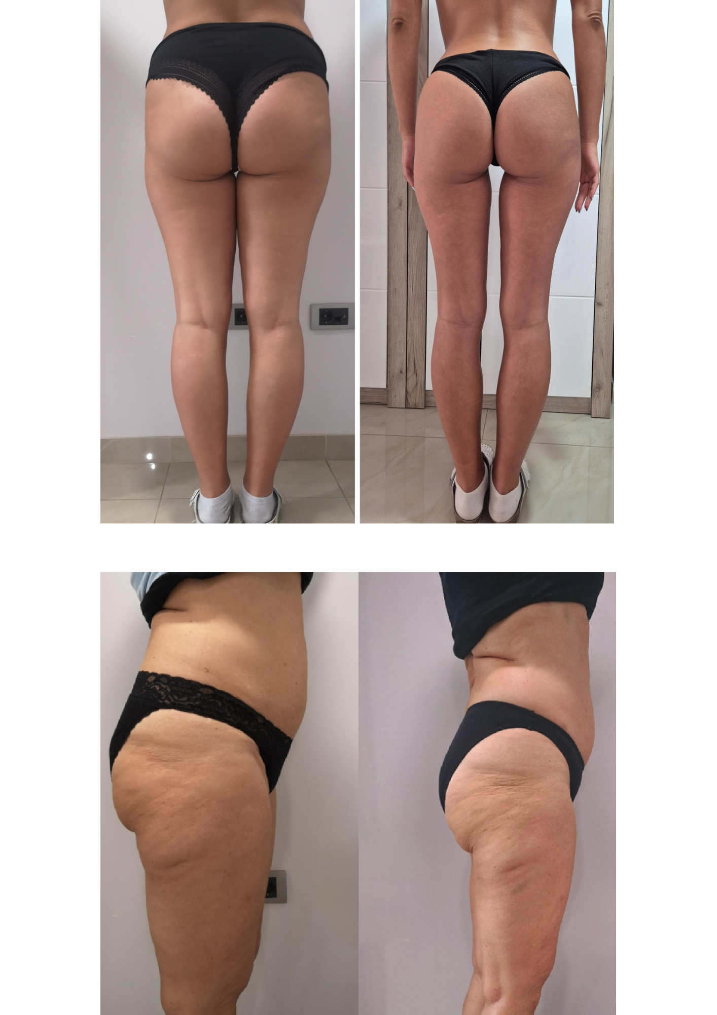 Rezultati nakon samo 5 nedelja posle TURBO paketa u BODY SENSE studiu.