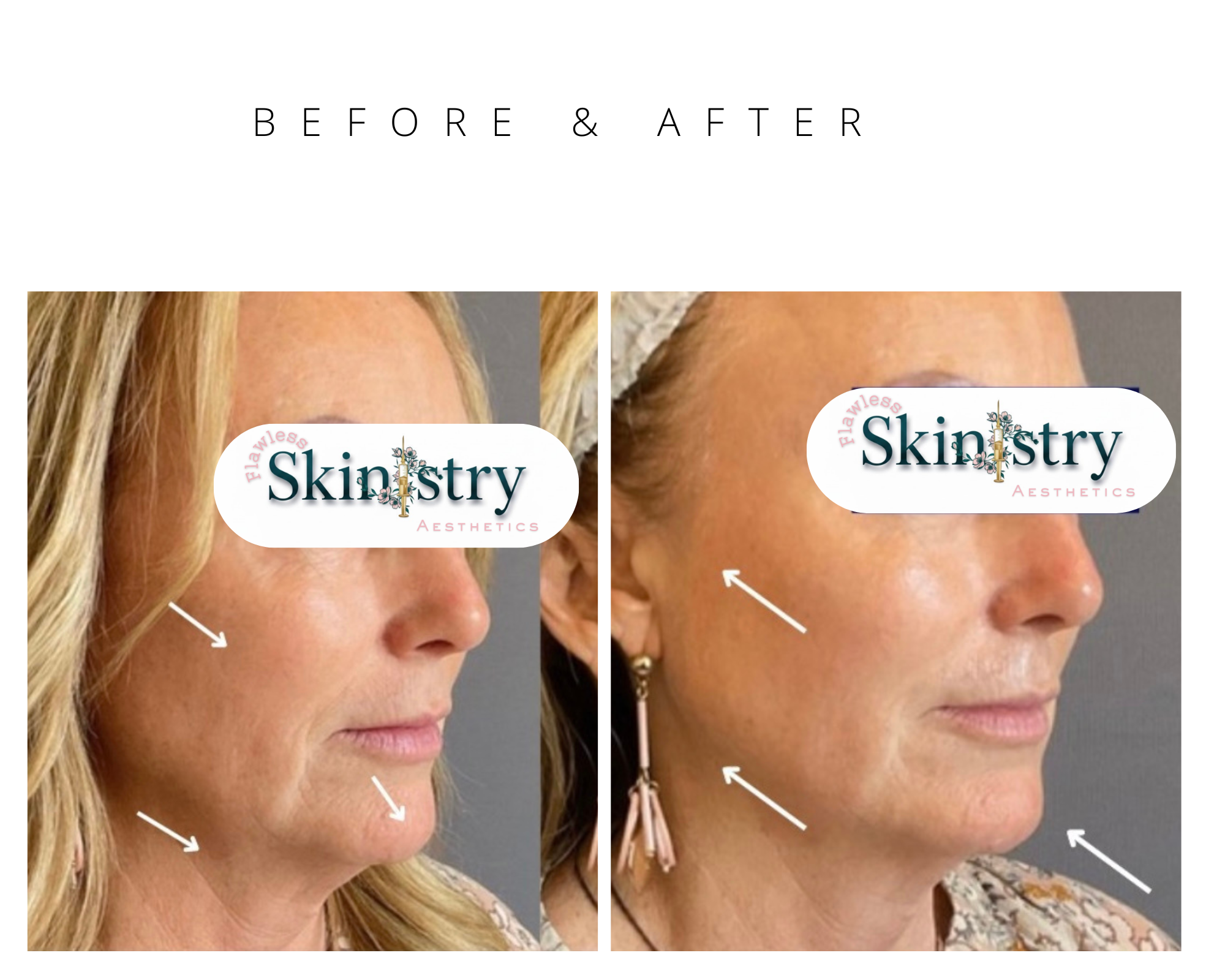 get rid of forehead wrinkles