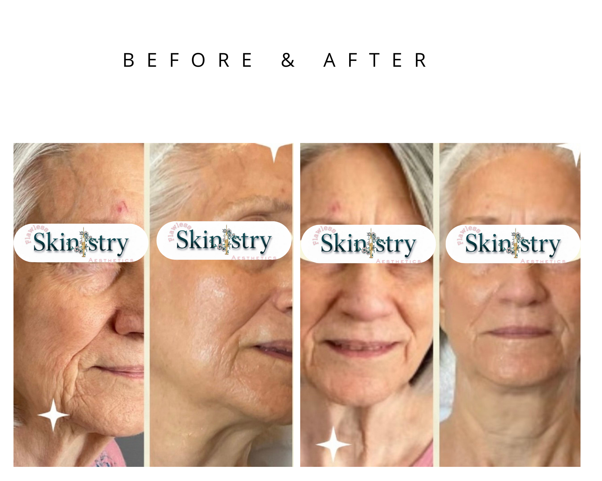 microneedling dallas