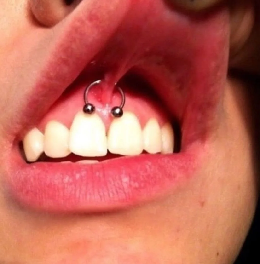 Smiley piercing example taught in online and hands-on body piercing classes