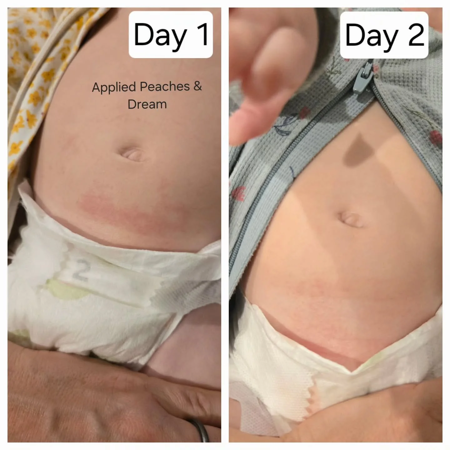 24hr difference in this diaper rash only using Peaches &amp; Dream deserved a special place on my feed.
