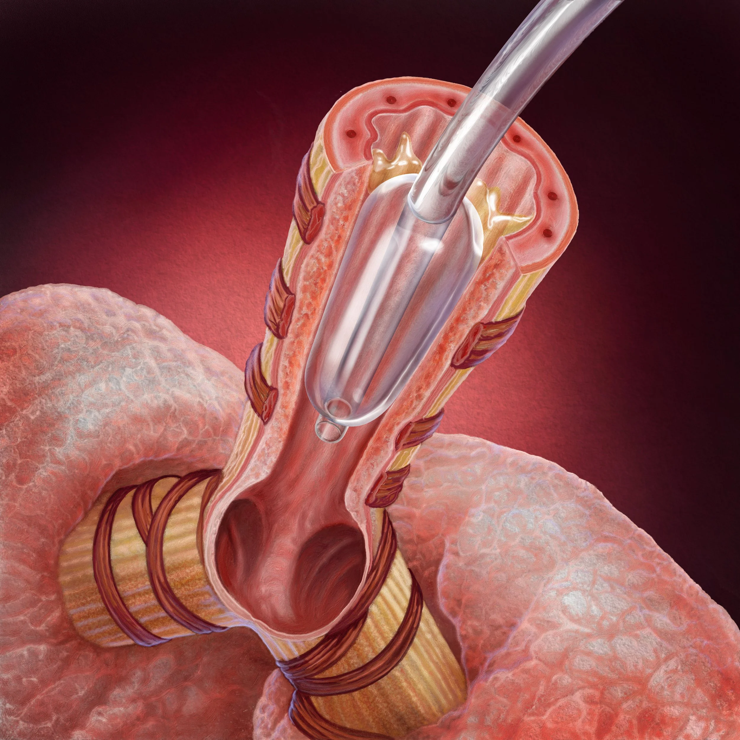Trachea Balloon B-5.jpg